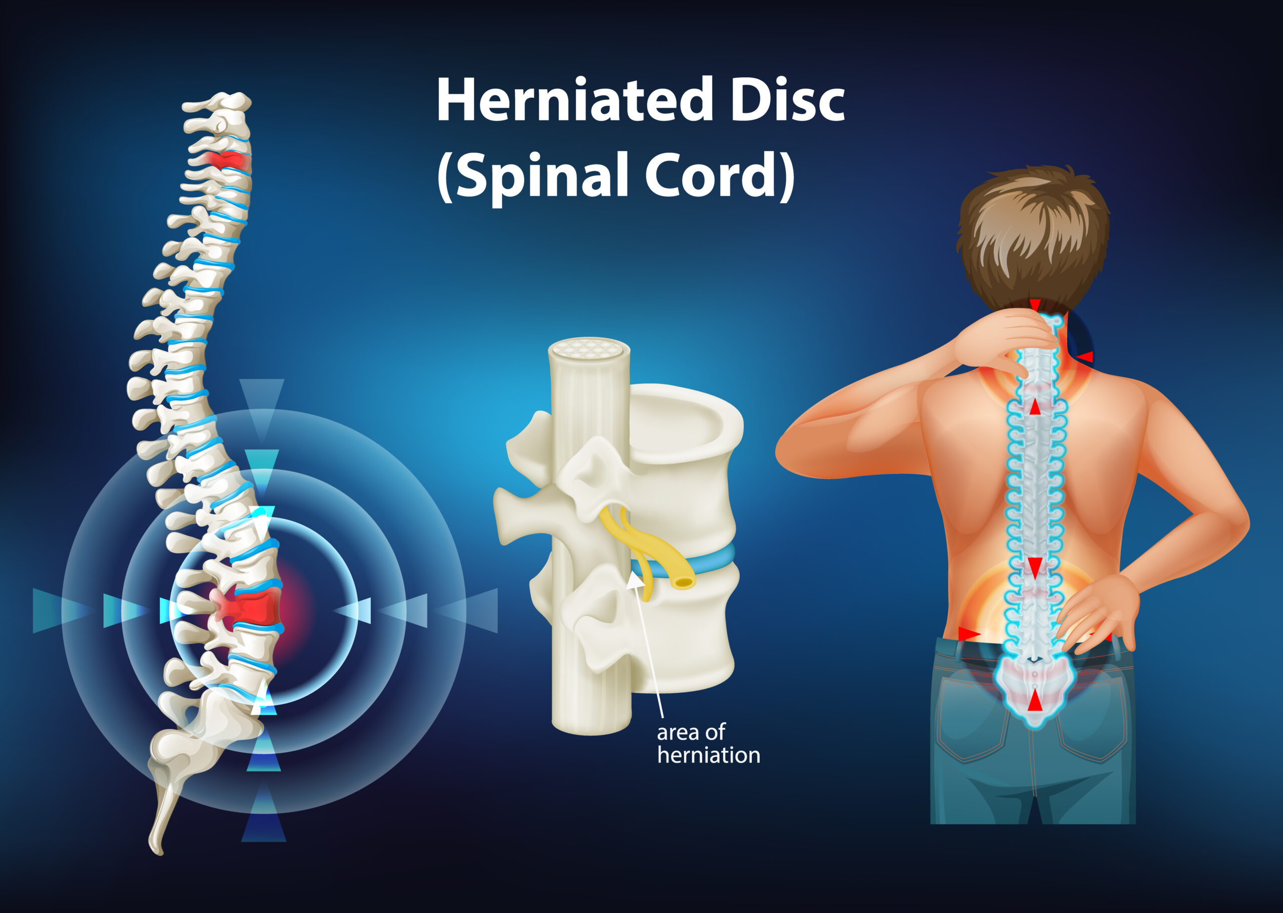 Understanding Disc Desiccation: How to Ease Back Pain and Improve Spine Health